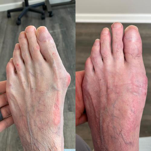 before/after foot picture