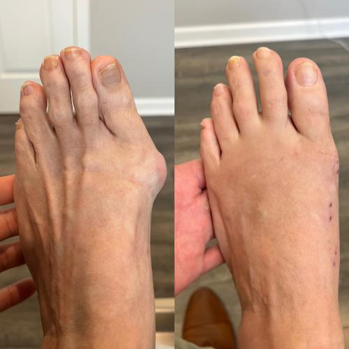 before/after foot picture