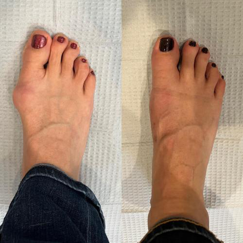 before/after foot picture