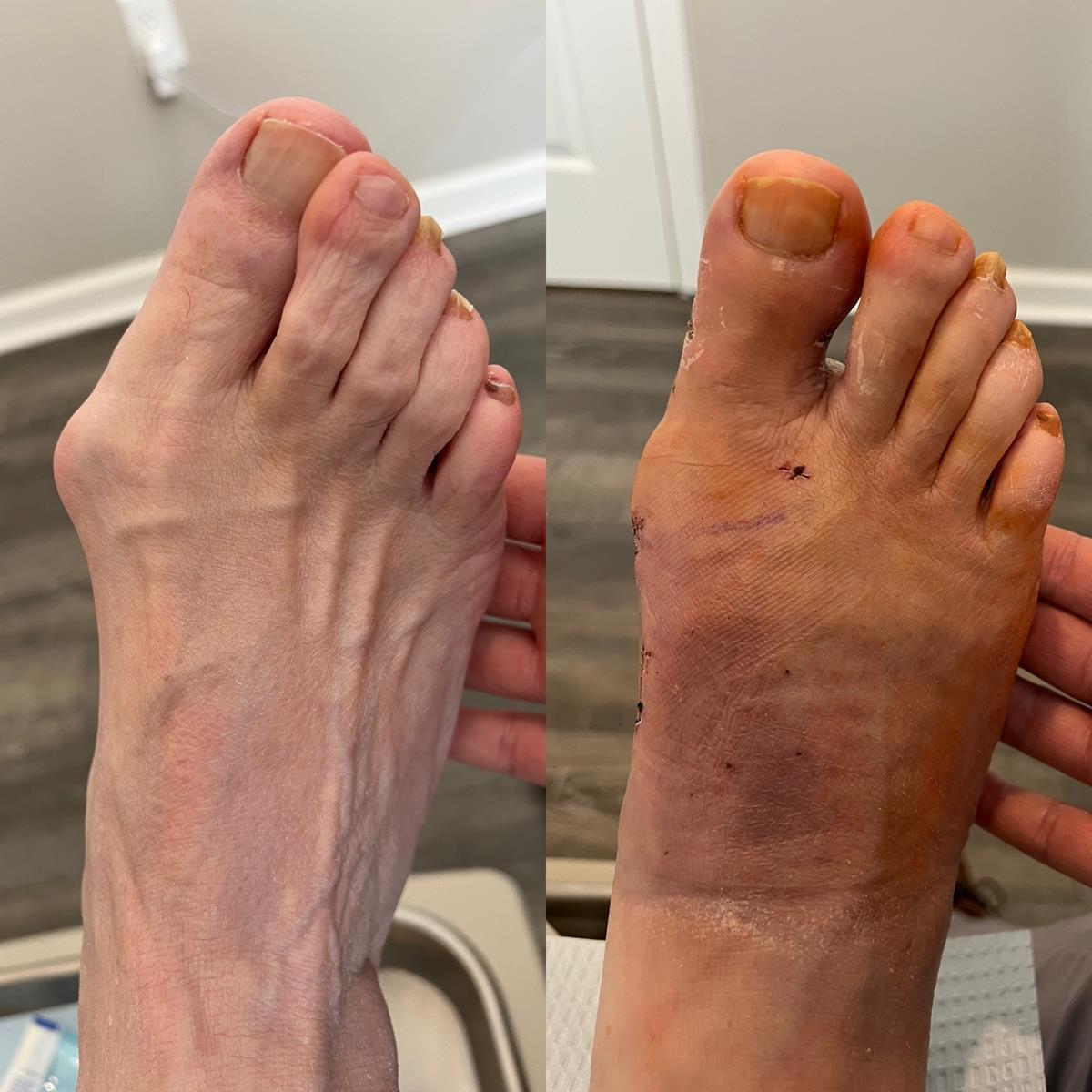 before/after foot picture