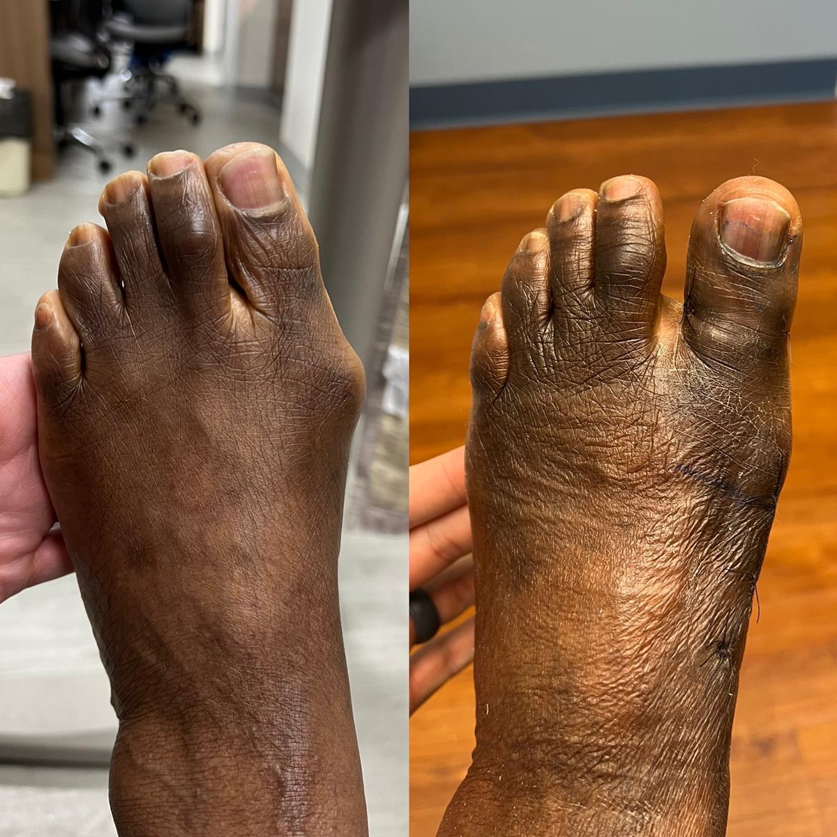 before/after foot picture