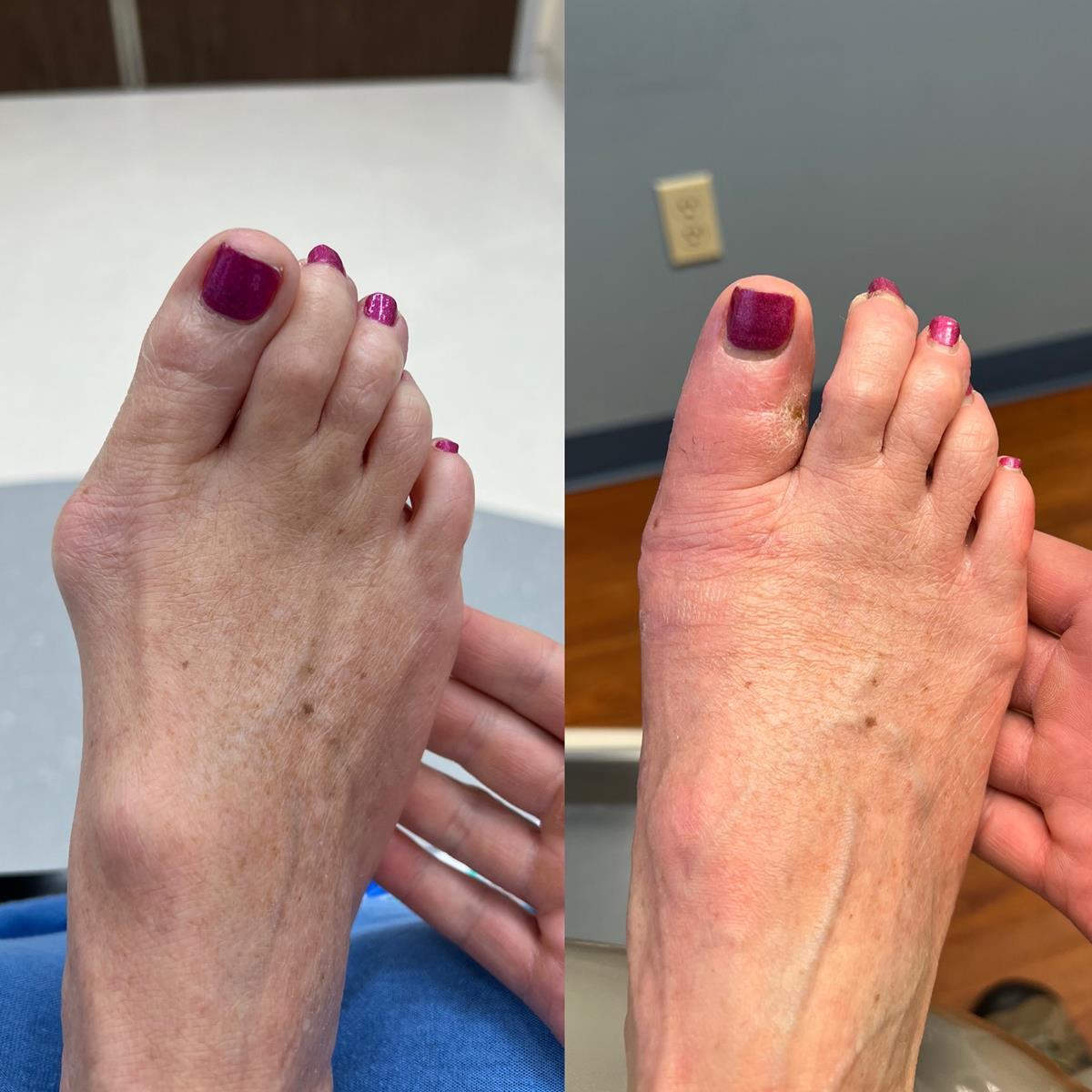 before/after foot picture