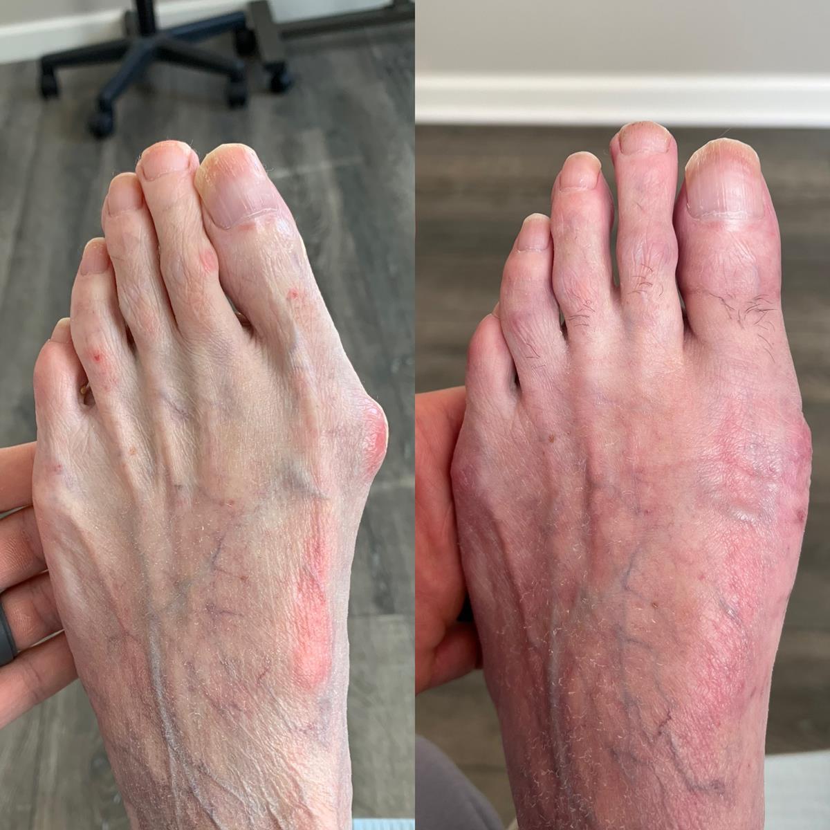 before/after foot picture