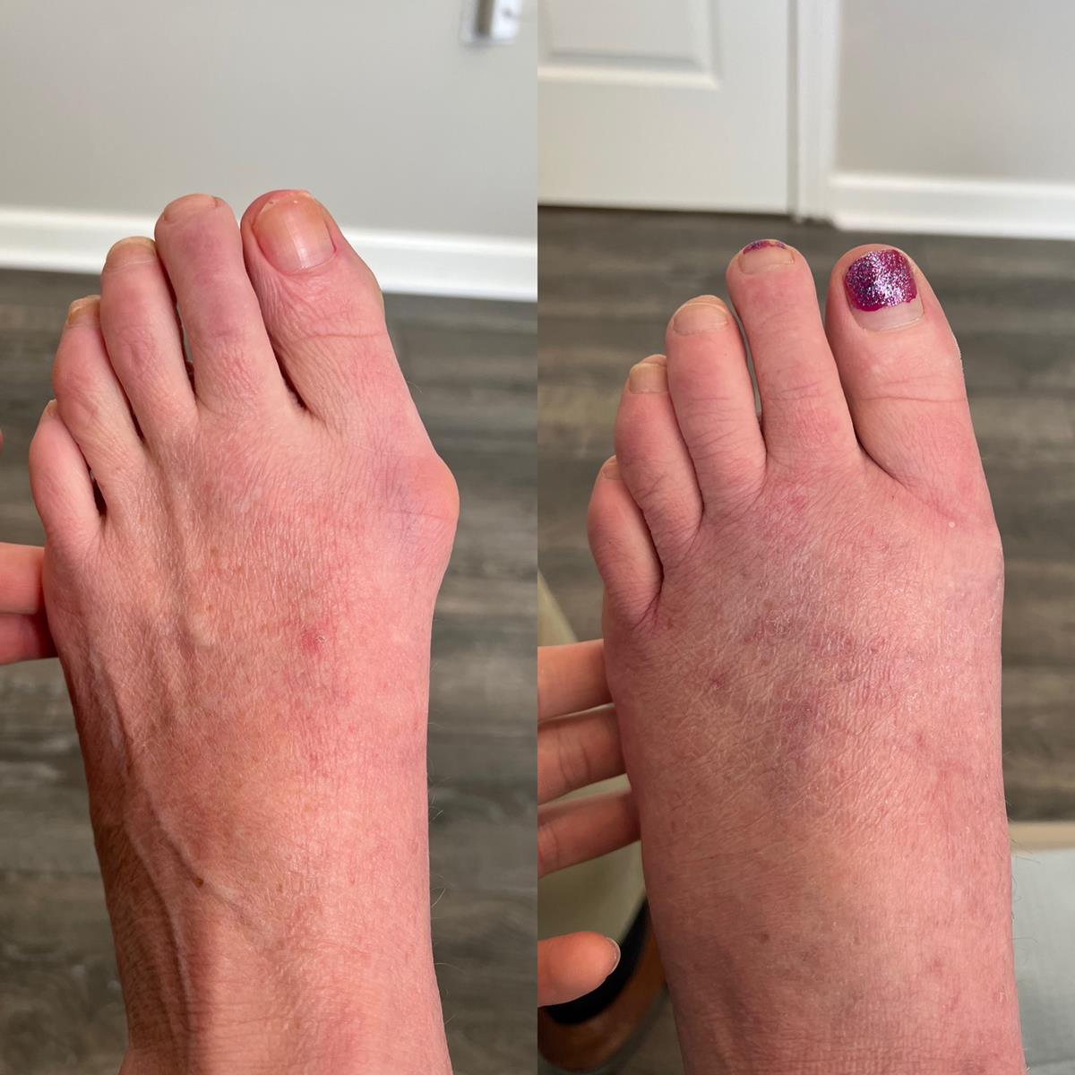 before/after foot picture